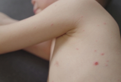 北市爆麻疹境外移入！「個案足跡」曝  出現這些症狀注意了