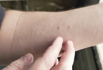 發燒＋紅疹小心！北部學生確診麻疹  疾管署示警「防疫關鍵」